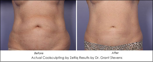 Fat Reduction | Loose Skin | Cellulite | Venus Freeze vs. CoolSculpting