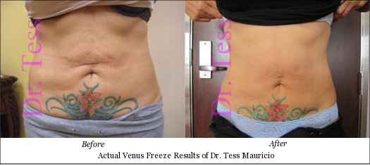 Fat Reduction | Loose Skin | Cellulite | Venus Freeze vs. CoolSculpting