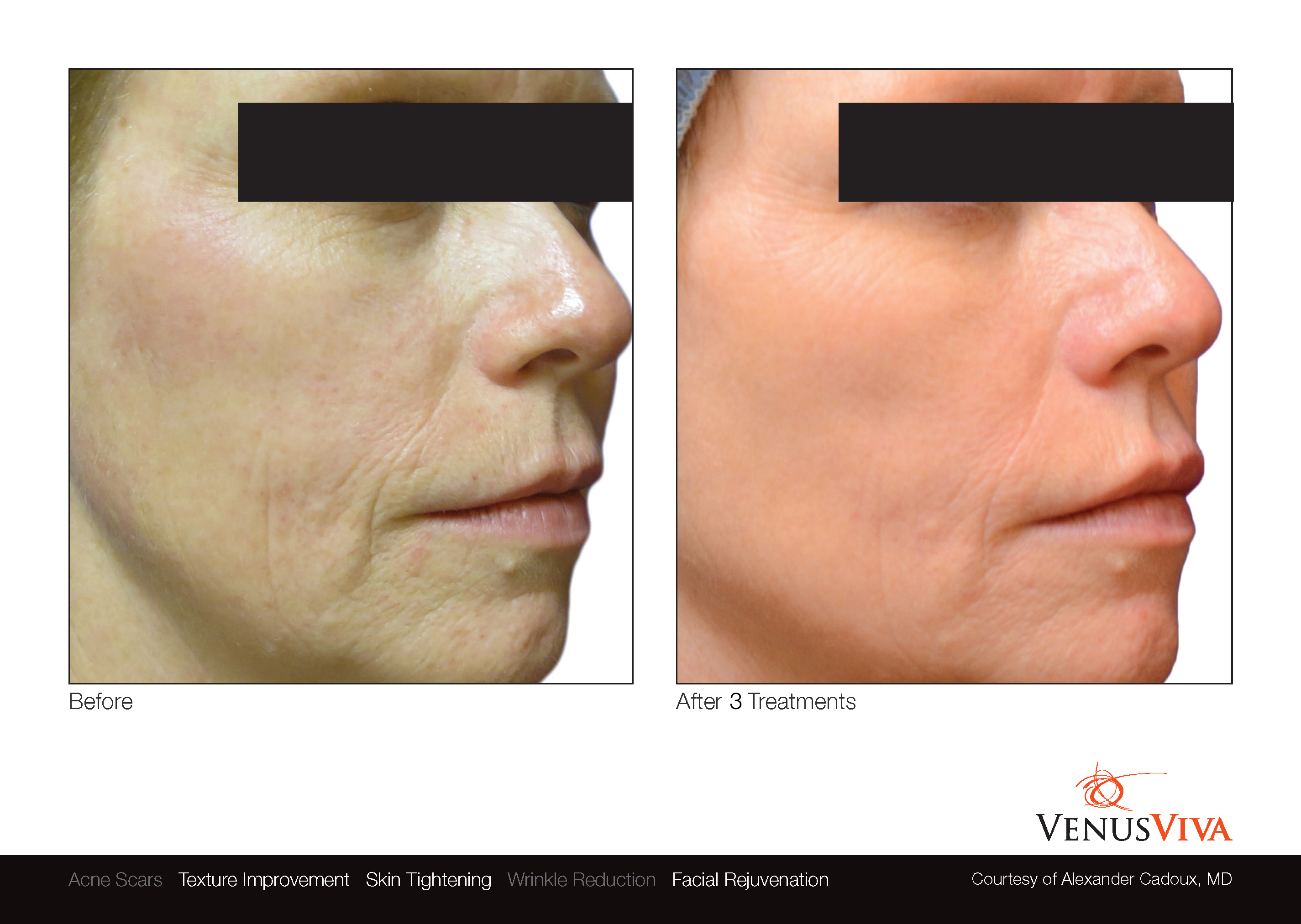 Skin Resurfacing Austin | Venus Viva | Texture Improvement | Skin Tightening | Before & After