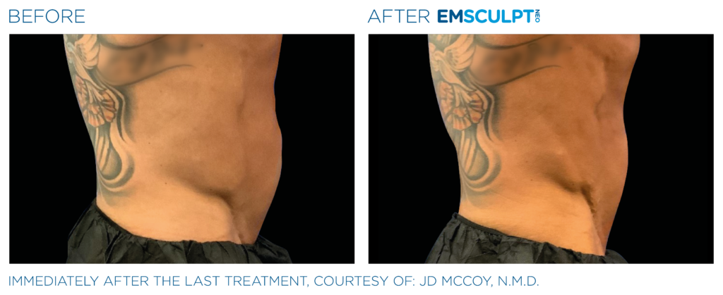 Emsculpt NEO Edge - Simple Radiance Medspa