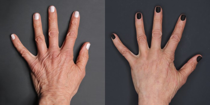 Before and After Using Renuva on Hands