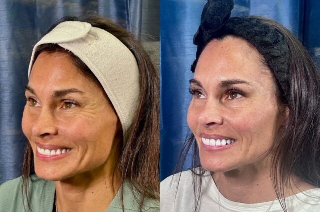 ✨ What Dysport Can Do For You

Subtle. Natural. Radiant.

These before & after results with Dysport show how softening expression lines can refresh the face without changing what makes you you. By gently relaxing the muscles that cause wrinkles, Dysport smooths areas like the forehead and frown lines while keeping natural movement and expression.

At Simple Radiance, our goal is never to make you look different&mdash;only more rested, more confident, and more radiant.

Ready to experience the difference intentional, natural aesthetics can make?
DM us to schedule your consultation. ✨

#SimpleRadiance #DysportResults #AustinMedSpa #NaturalAesthetics #RadiantSkin